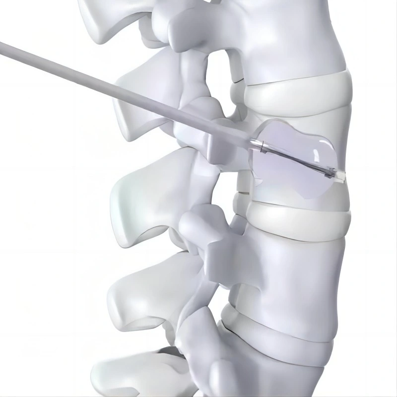 Cifoplastia Juego de herramientas de Vertebroplastia instrumentos espinales PVP hueso Relleno de cemento