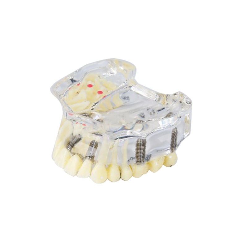 Implant Model for Showing Implant and Restoration Caries