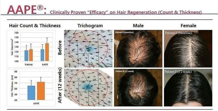 Crecimiento de Aape Hair extraído del patrón de células madre adiposas humanas Calvicie Prevención de la pérdida de cabello hombres mujeres Microgeedling crecimiento del cabello tratamiento de suero