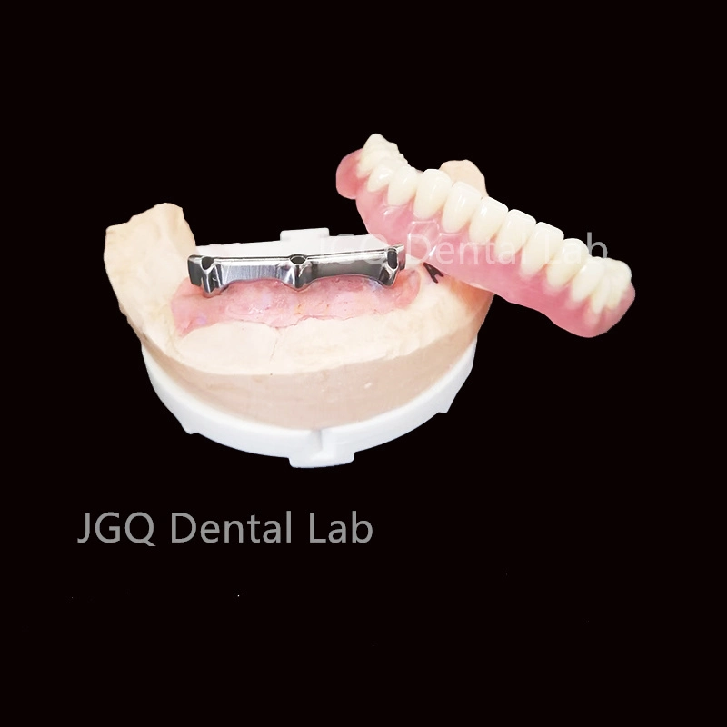 All on 4 Dental Prosthesis Titanium Implant Supported Overdenture Bar