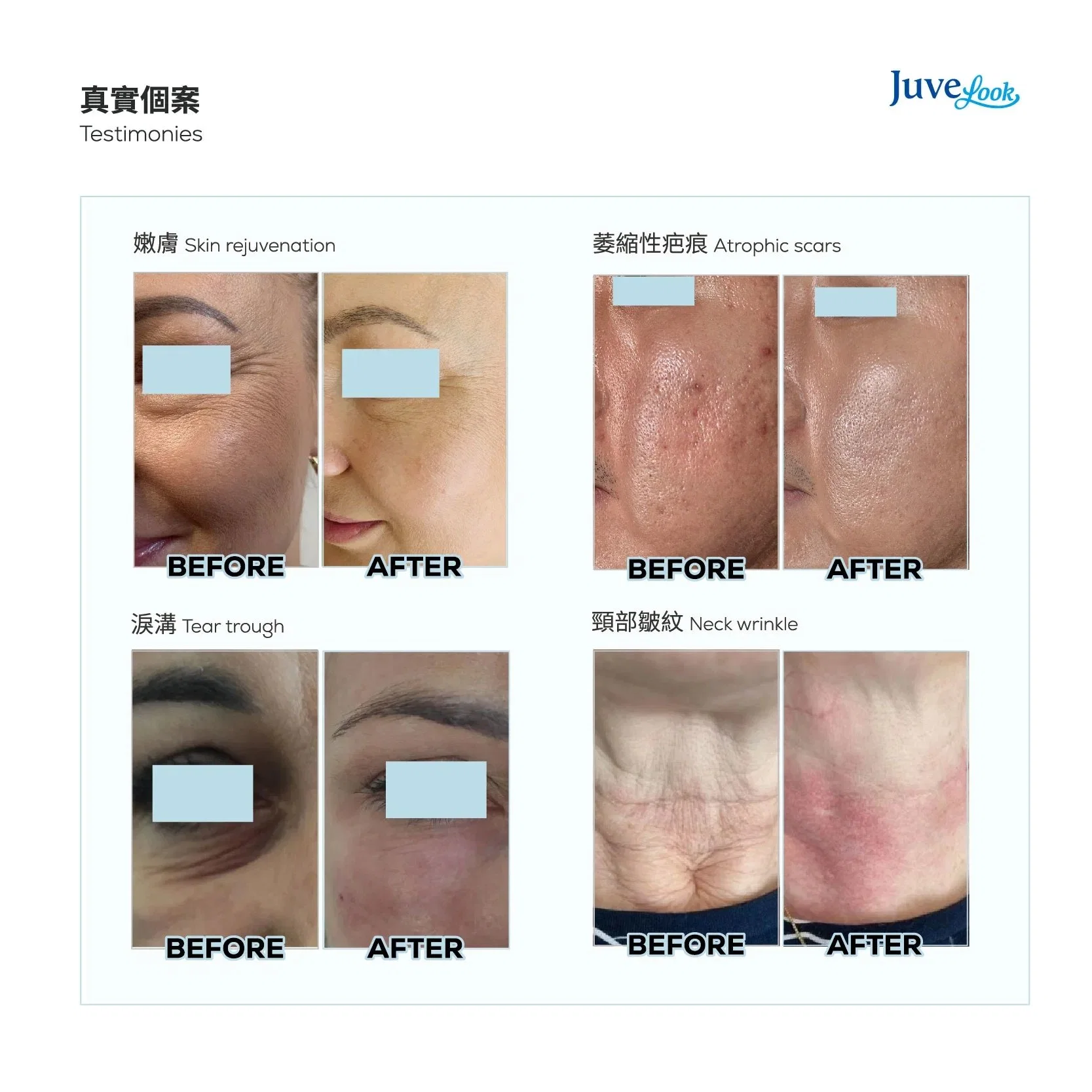 Original Juvelook 50mg Plla Ha Hybrid Filler CE Mark Elastic Rejuvenation Booster Regeneration Repair Olidia