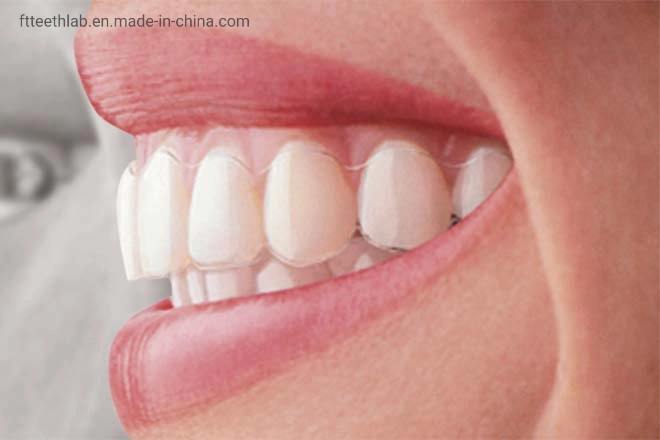 Unsichtbare orthodontische Tabletts hergestellt in China Dental Lab aus Shenzhen China, Die Ihre Unebenen Zähne Ausrichten Können