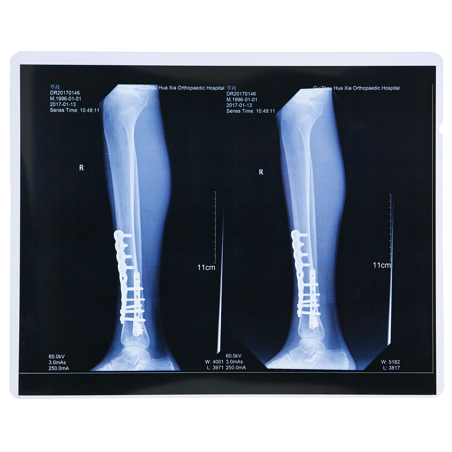 Medical Film Xray Image Printing Use Blue Xray Film Pet Medical Film