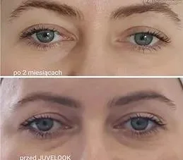 FDA CE Lenisna Aesthefll Aesthe Fill Etrebelle Powerfill Sulptr colágeno Inyección PLA+ha Hybrid Filler Juvelook 50mg Inyección de relleno Dermal