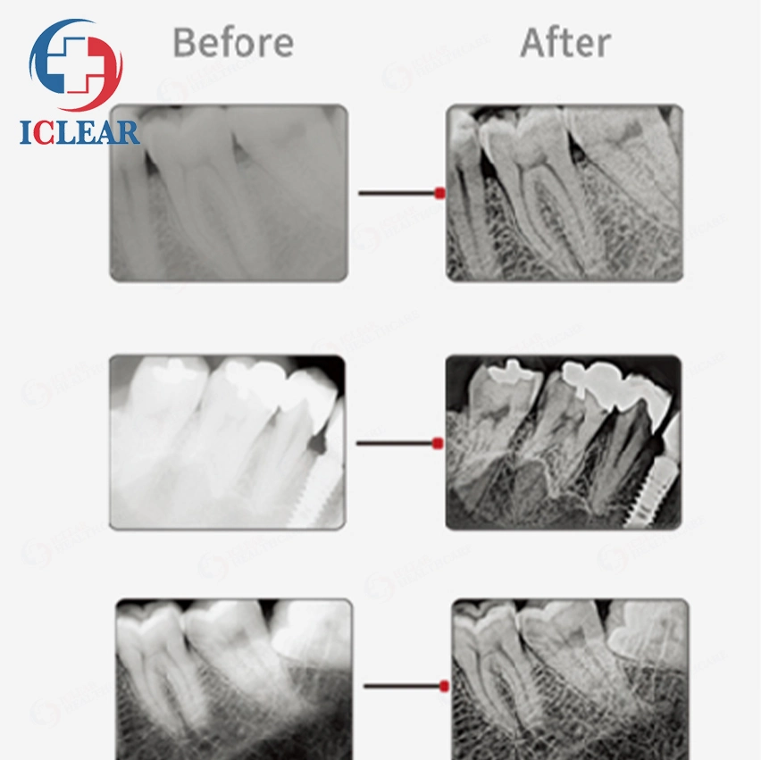 أداة استشعار صور الأسنان أداة استشعار الأشعة السينية للأسنان