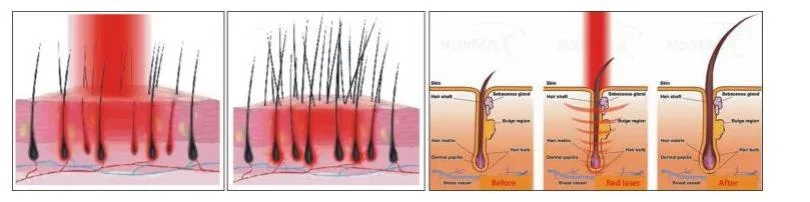 Terapia profesional de rebrote de cabello Salón de belleza Equipo de cosméticos