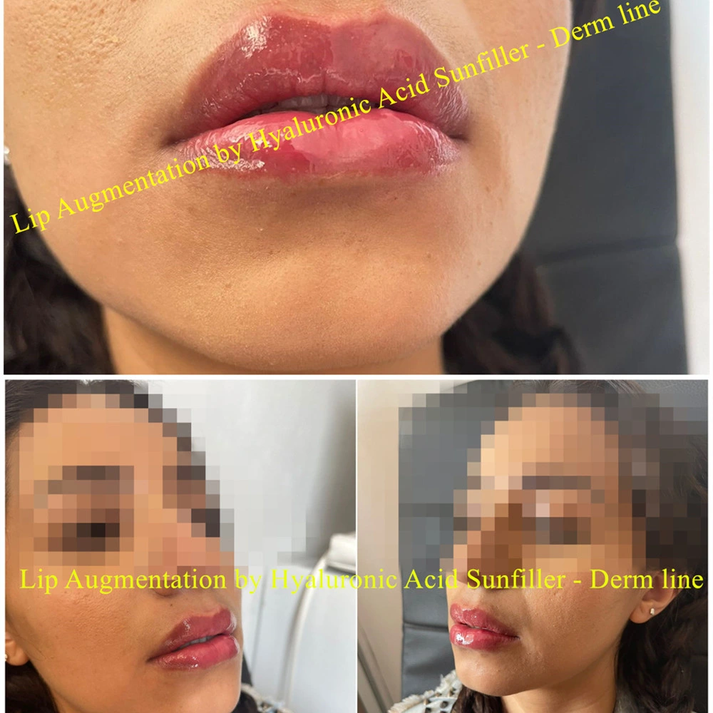 2 ml de enchimento dérmico por absorção solar de ácido hialurónico para plenitude labial