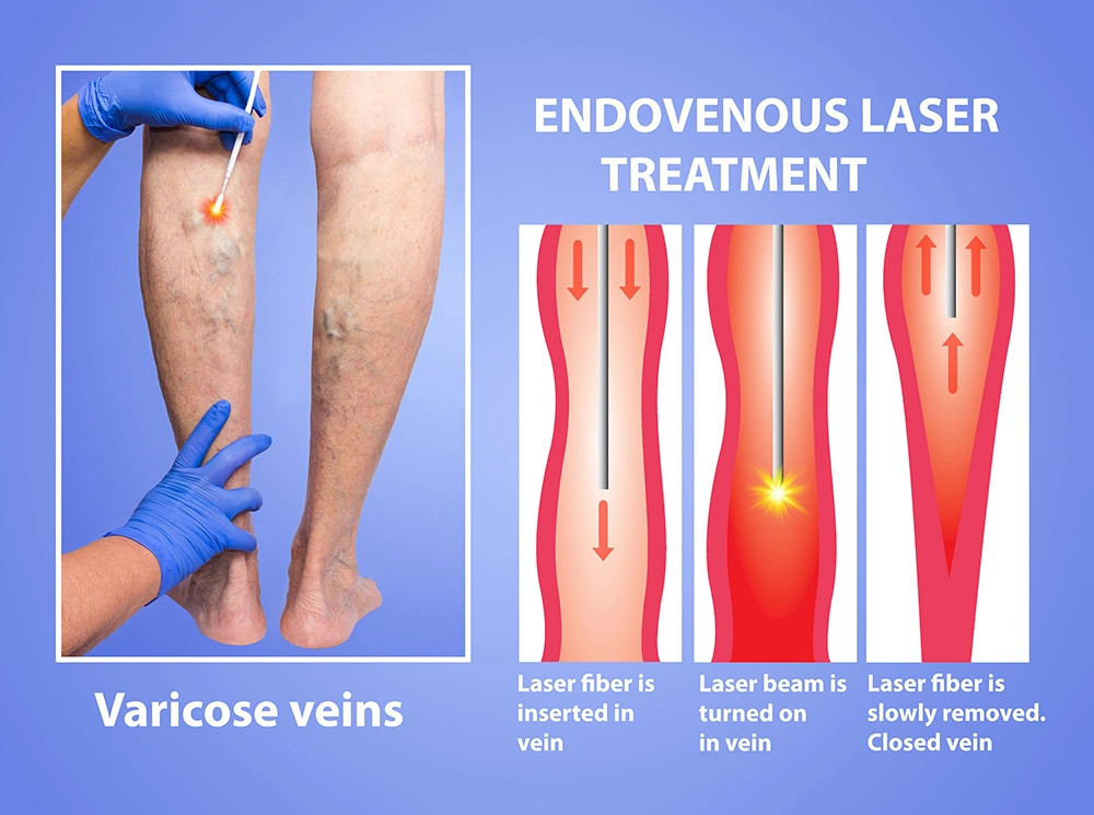 980nm Diodo láser Vascular EVLT láser quirúrgico EVLT Fibra portátil Diodo láser 1470nm