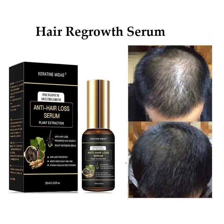 Hair Thinning Loss Products Nourish Remove Dandruff Anti Hair Loss