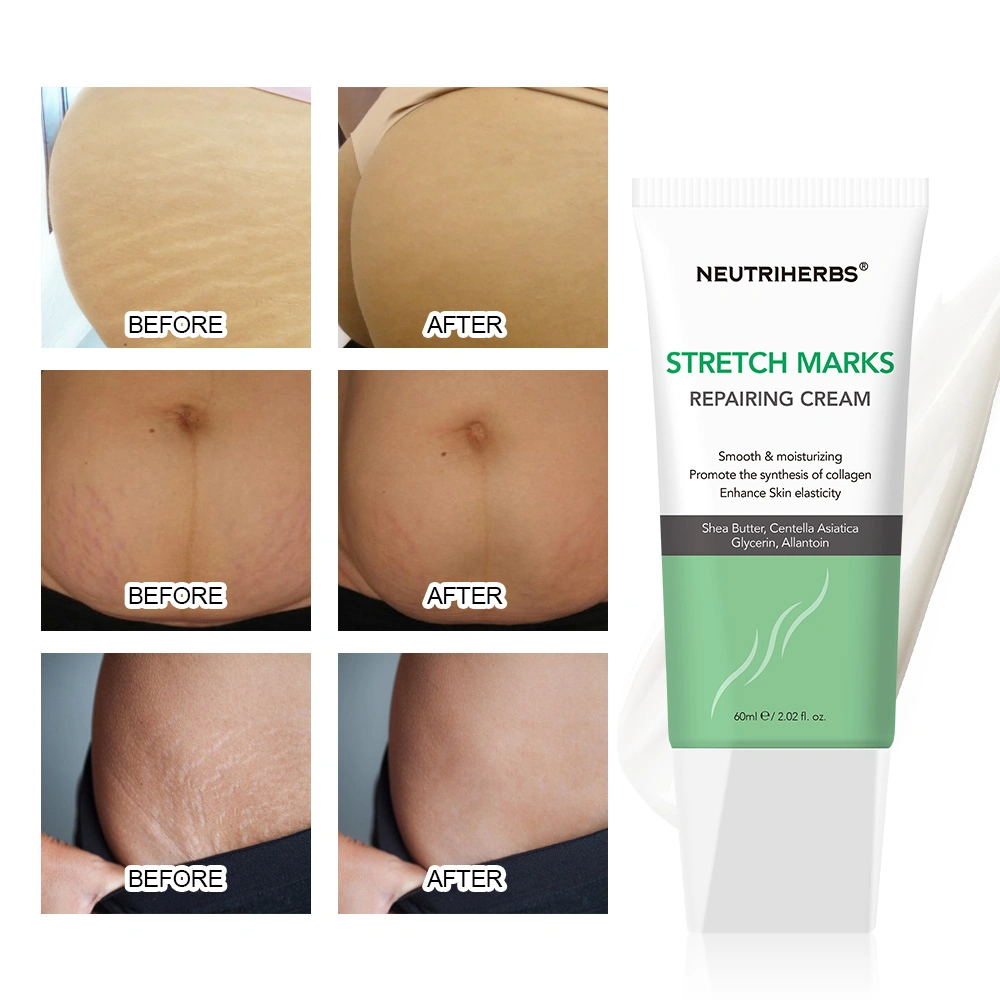 Private Label Remove Stretch Marks Repairing Smooothing Skin Stretch Mark Cream