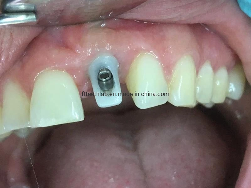 Arco completo fixado de Implantes Dentários Bridge para reabilitação bucal