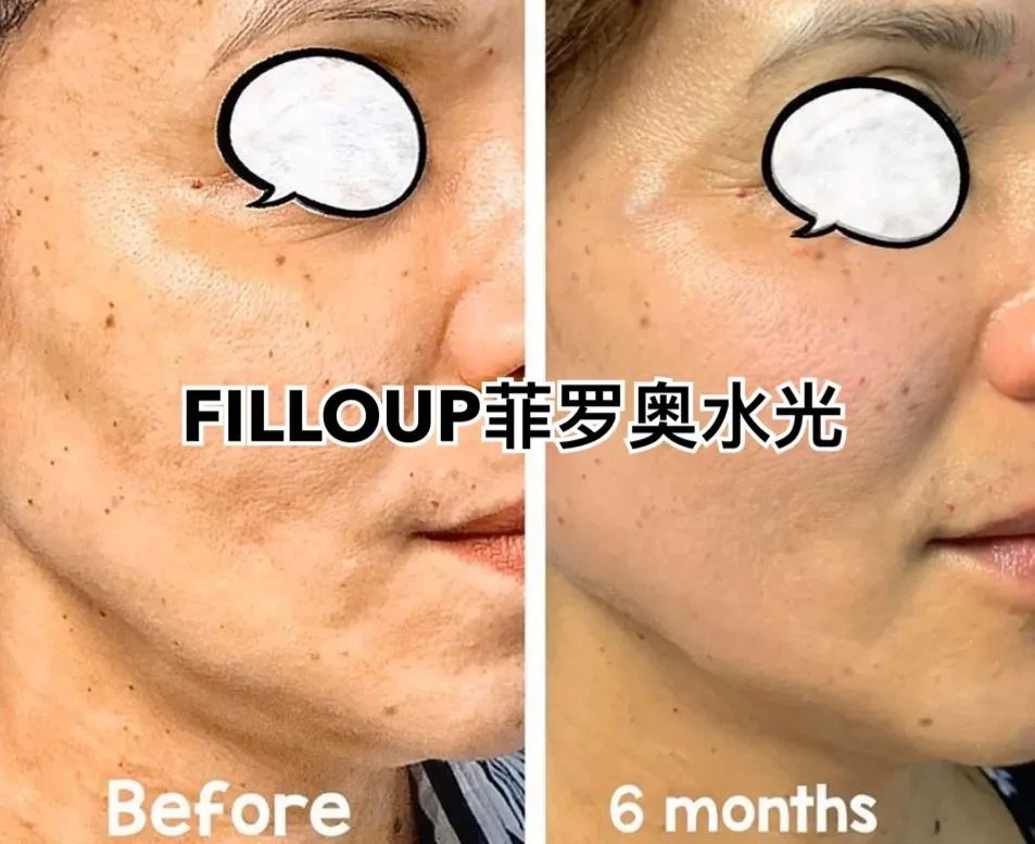 Korea Filloup Pcl Anti Aging Thin Face Skin Booster Contains Intocell Repair Factor Polycaprolactone 3 Peptide Complexes Promote Cell Regeneration