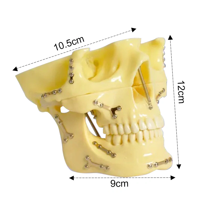 Fixed Bone Fracture with Titanium Plate and Ortho Implant Dental Skull Model