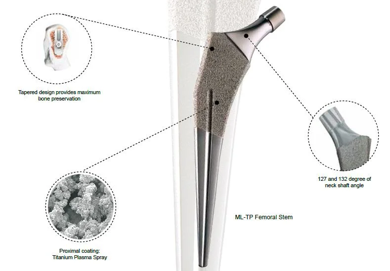 Mejor Precio prótesis femoral artificial de cadera sin cemento Implantes ortopédicos