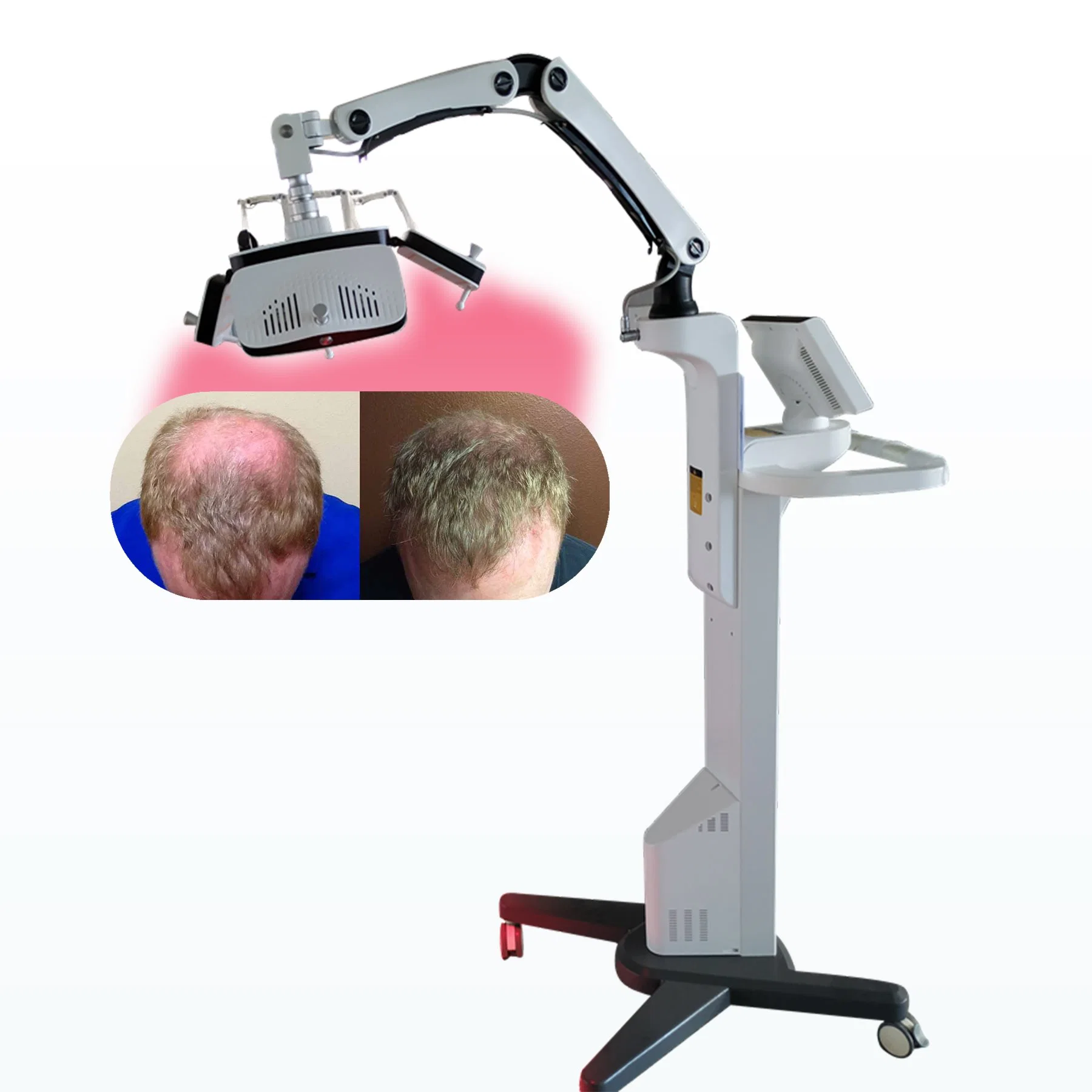 Professionelle Haarwachstum Haarausfall Diode Laser-Behandlung für Salon