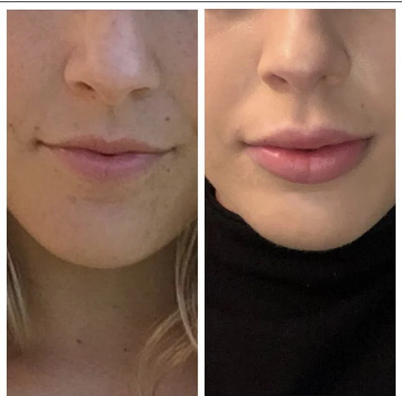 شهادة CE عبر الحدود Ha Dermal Filler Lido Injection Ha حشو ليدو من النحت لحقن النحت مع ليدو بنسبة 3%