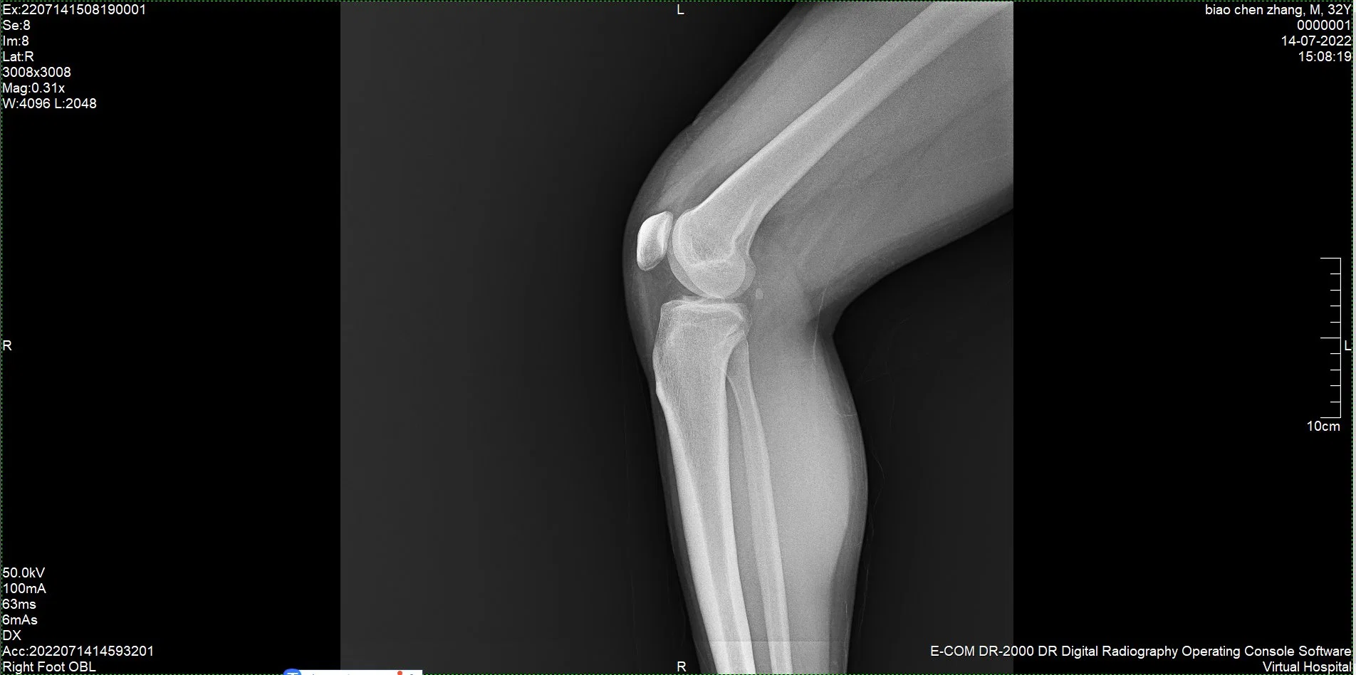 جهاز تشخيص التصوير الإشعاعي للثدي الطبي Careray Medical Mammography Diagnostic محمول لاسلكي بقياس 17"17"" DR X Ray جهاز الكشف ذو اللوحة المسطحة