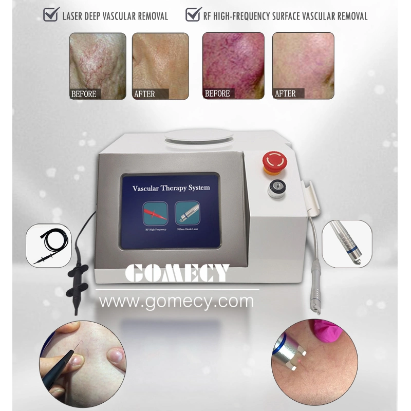 Portable 980nm Laser Vascular Spider Vein Removal Diode Laser Beauty Equipment with 30W