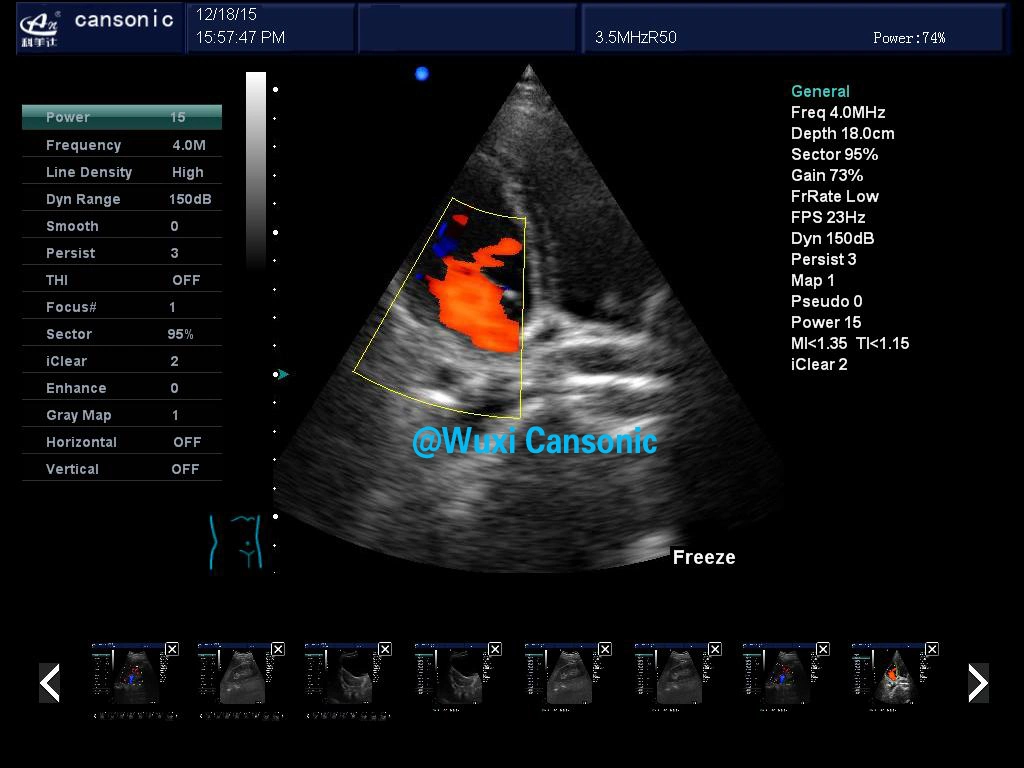 Hot Sale Trolley Color Doppler Ultrasound Machine