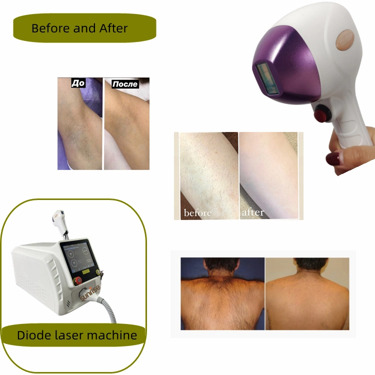 2023 Popular Alexander Diode Laser Permanent Hair Removal Beauty Machine Diodo Laser Hair Removal Alexandrite Laser 755nm Depilation Salon Equipment