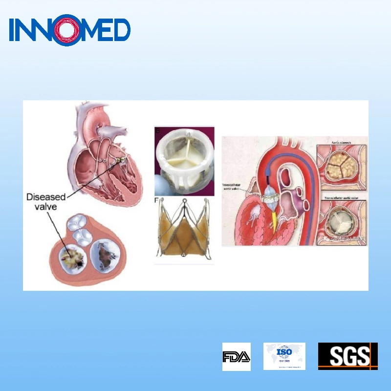 Nickeltitanium Wire Core Coronary Guidewire for Establishing Intravascular Access