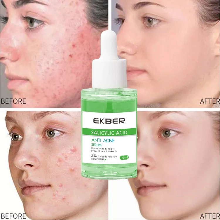 Private Label Organic Gesichtsbehandlung Akne-Spots Clearing Haut Beruhigendes Scar Fading Anti Akne Serum