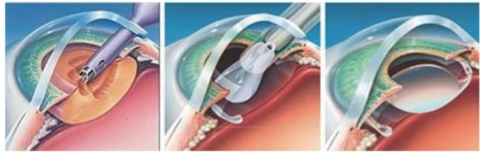 OEM, Obl, Distribute with Logo Printing Retinal Detachment Surgery Viscolastic Solution