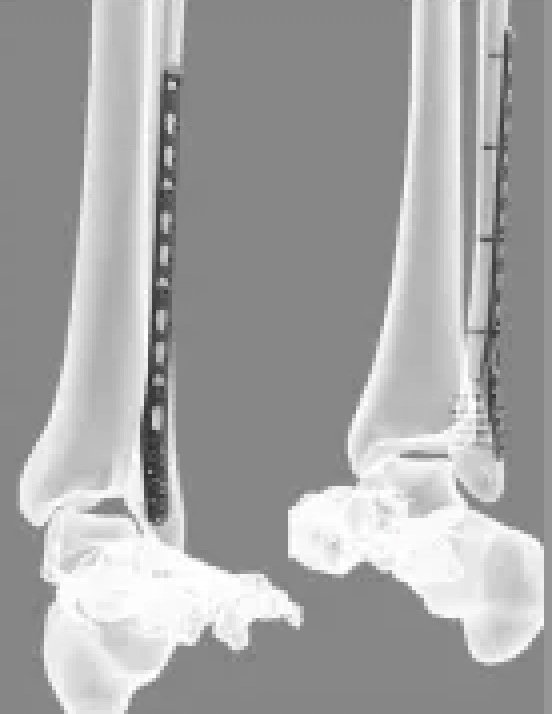 Placa de titanio ortopédica hueso sistema médico de peroné Distal Anatonic placas de bloqueo