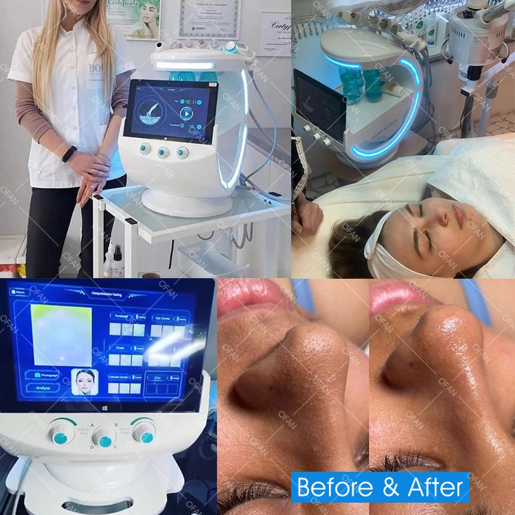 Ofan Smart Azul hielo agua Oxgen húmedo Facial Microdermoabrasión Aqua Jet dermoabrasión peeling de H2O2 Máquina Hydrafacials