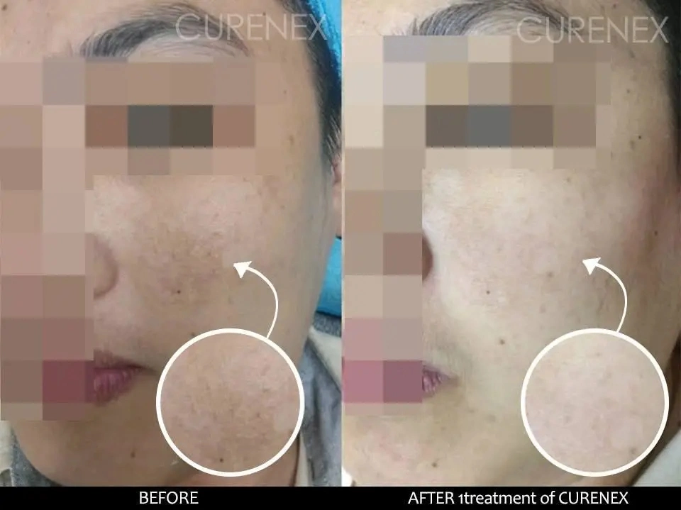 Curenex Pdrn Korea Curenex Skin Rejuvenating Ampoule Skin Booster Revitalizing Solution Lifting The Skin