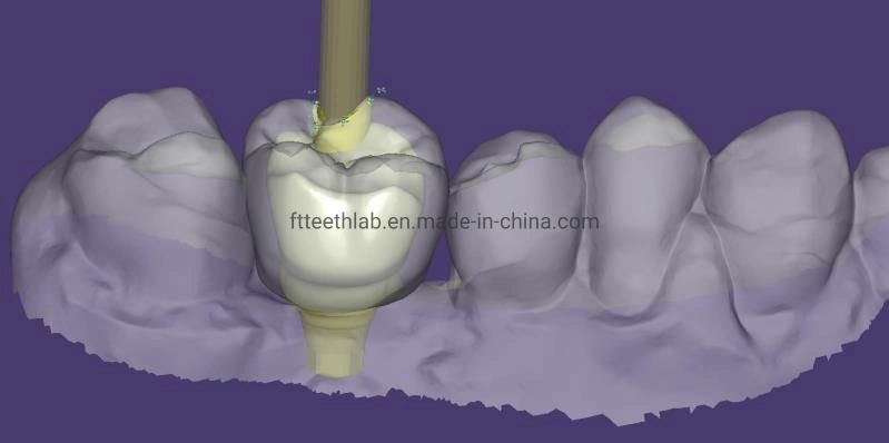 Implant dentaire couronnes en céramique de métal et le pont de la Chine