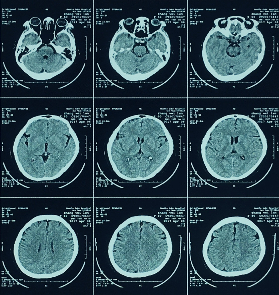 Radiology Medical Dry Film/Dry Thermal Film 35X43 Cm