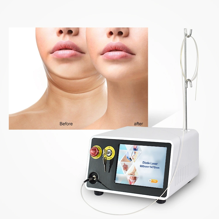 Professionelle 980nm+1470nm Laser Liposuction Maschinen Chirurgische Liposuktion Face Lift Equipment