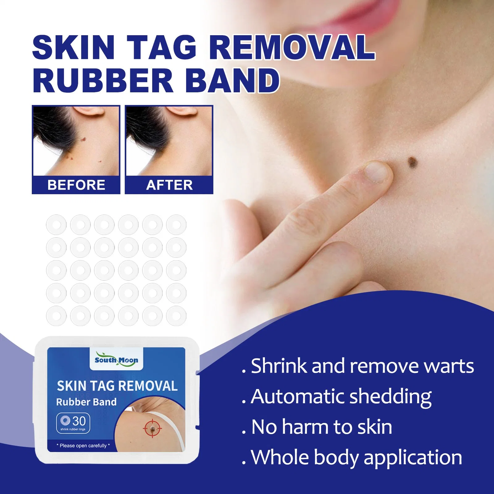 Skin Tag Remover Band Mole Wart Acne Pimple Patch Removal Spot