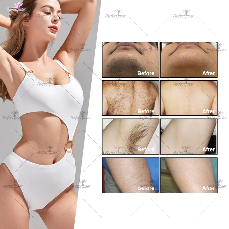 Bikini 1064 755 808 con depilación láser tratamiento para la belleza Equipo