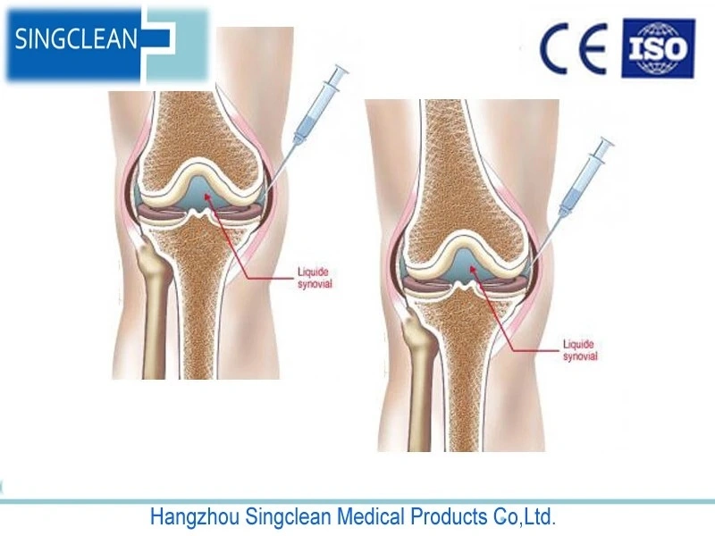 Гиалуроновая кислота Singjoint совместных гель для Osteoarthritis/ортопедии с маркировкой CE