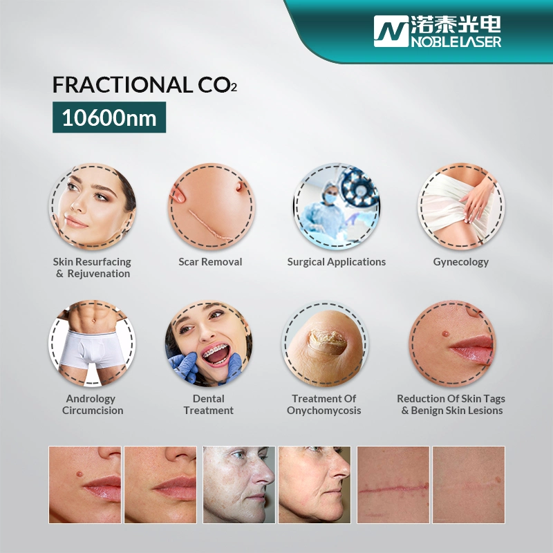 CO2 Factional Laser Beauty Salon Equipment for Scar Removal