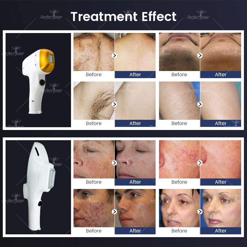 FDA IPL Laser Hair Removal Fast Skin Rejuvenation Customizable Device