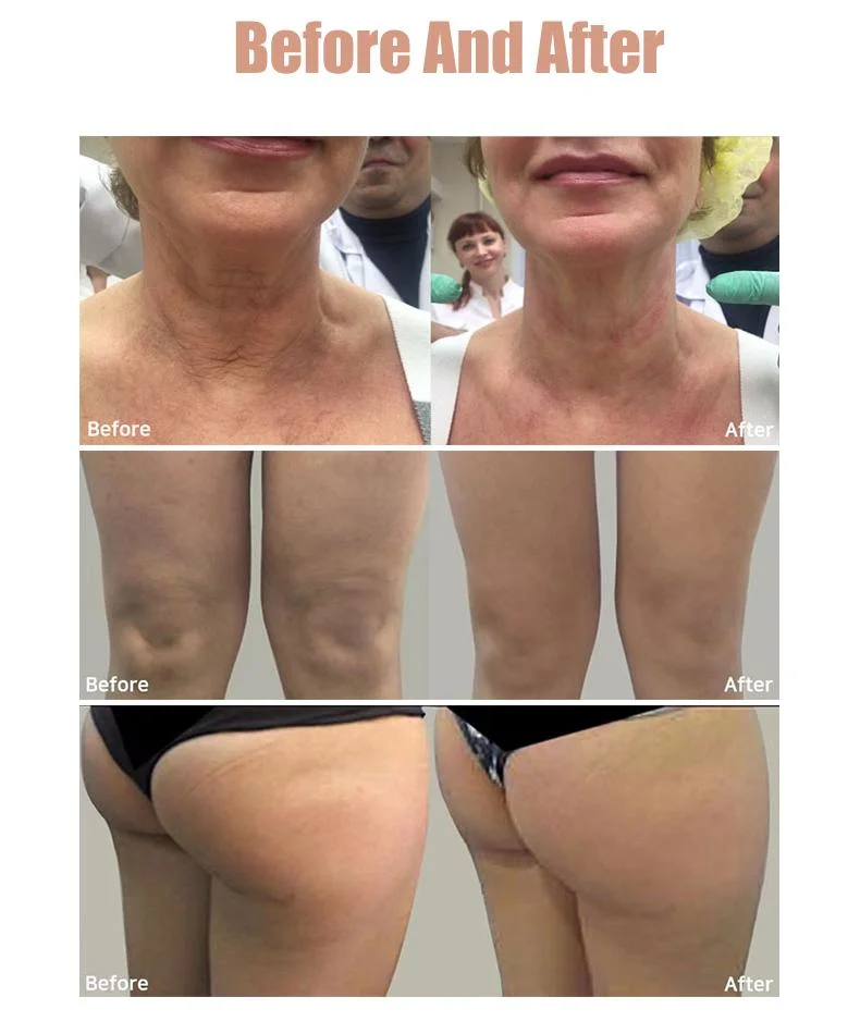 Facial antiarrugas cuerpo Slimming Doco ultrasónico 7D 9d HIFU