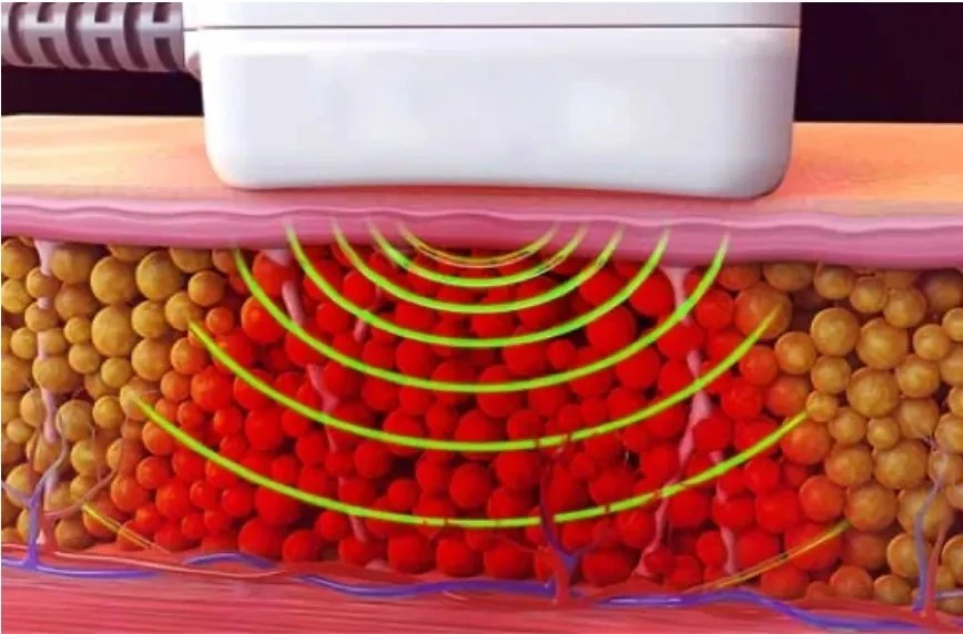 ID de Trusculpt e ID de Trusculpt Flex redução de gordura de radiofrequência Máquina promover regeneração de colágeno Trushape