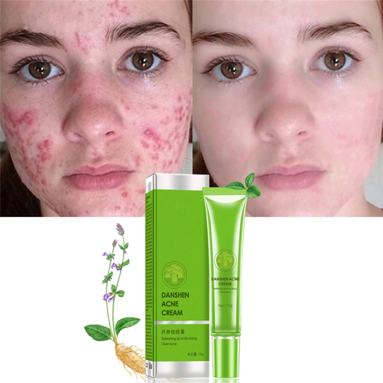 كريم Acne Moisturizing تساعد العضلات المهدئة على تحسين العناية بالبشرة