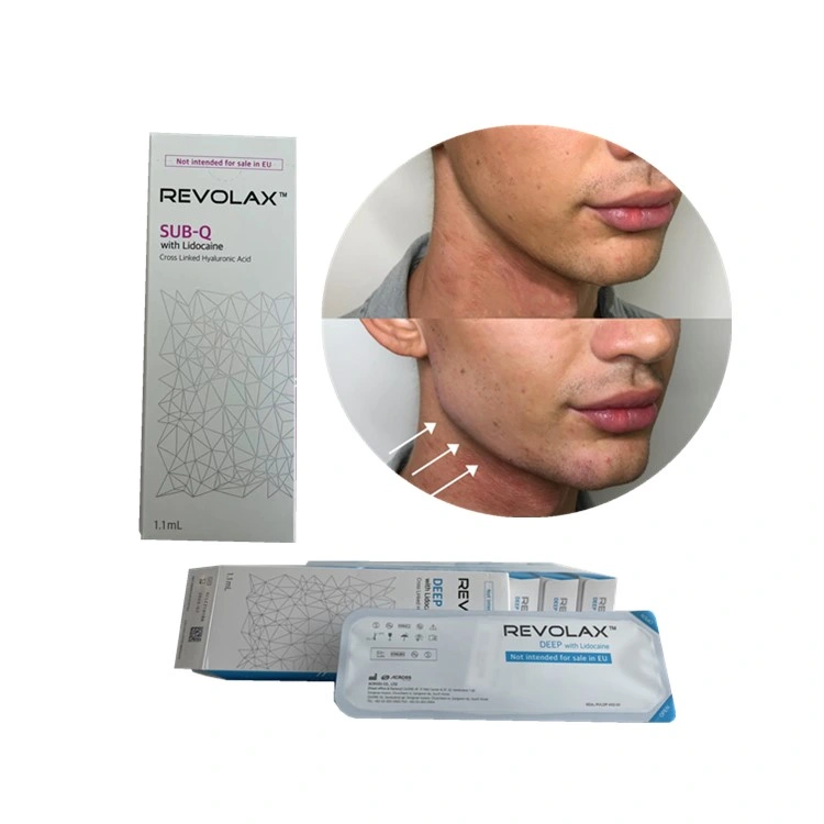 Revolax Hyaluronic Acid Deep Dermal Filler for Jawline Cheek