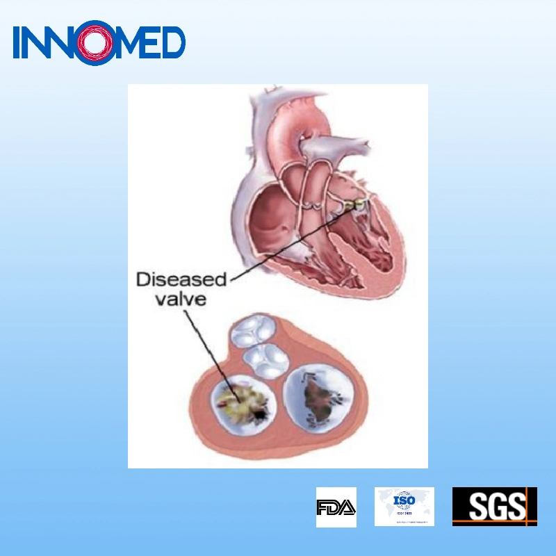 Inno Tavi-Wire for Establishing Access