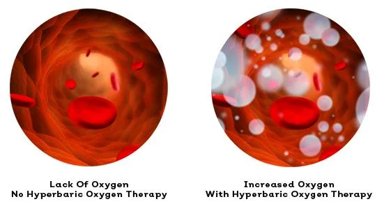 Hyperbaric Chamber Oxygen Capsule Oxygen Tank