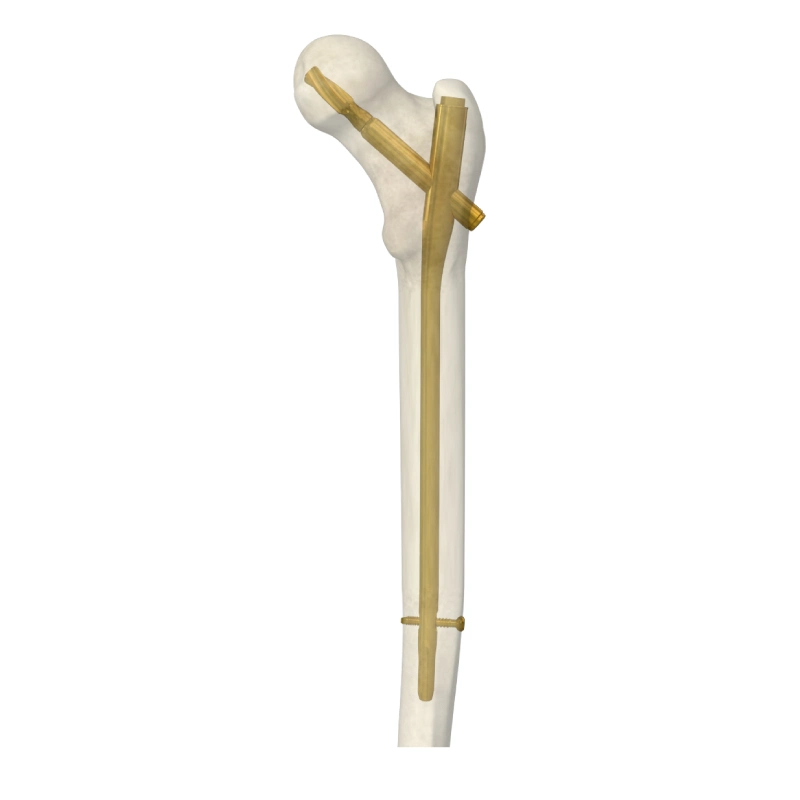 Médical Orthopédie reconstruction fémorale Nail intramédullaire Nail emboîtable Femur