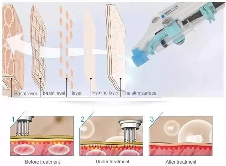 Appareil de beauté faciale aiguille de Mésogun injecteur peau blanchissant rajeunissement acné Pistolet méso de levage de la face de traitement