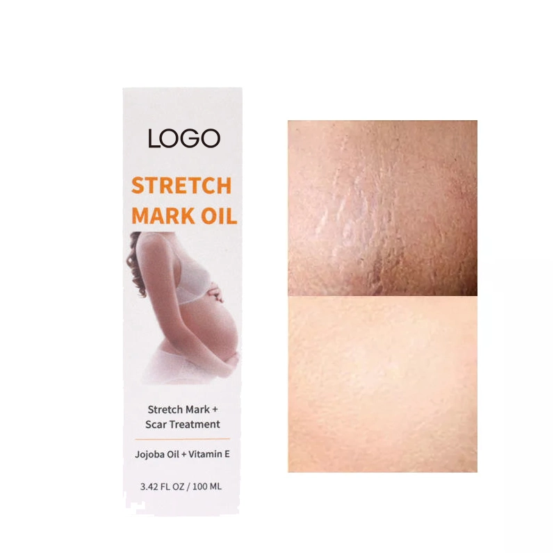 Essential for Foot SPA Repair Cream Suppliers of Removal Stretch Mark Oil