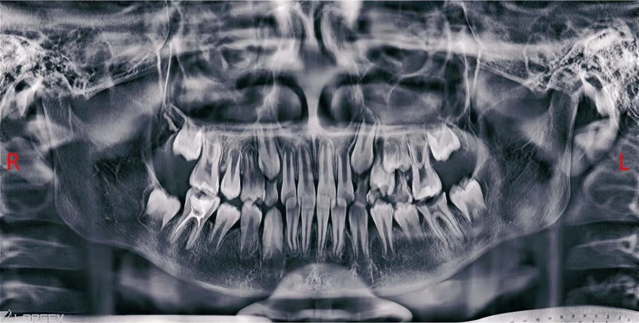 Smart 3D 2D Medical Digital Panoramic Cephalometric Cbct Dental X-ray Equipment for Endodontic Diagnosis with CE Certificate