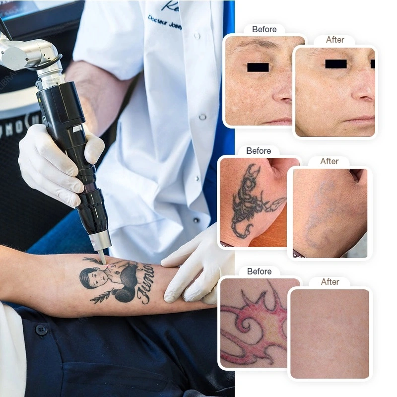 Professional Laser Picosecond Carbon Peeling Picolaser Tattoo Removal Machine