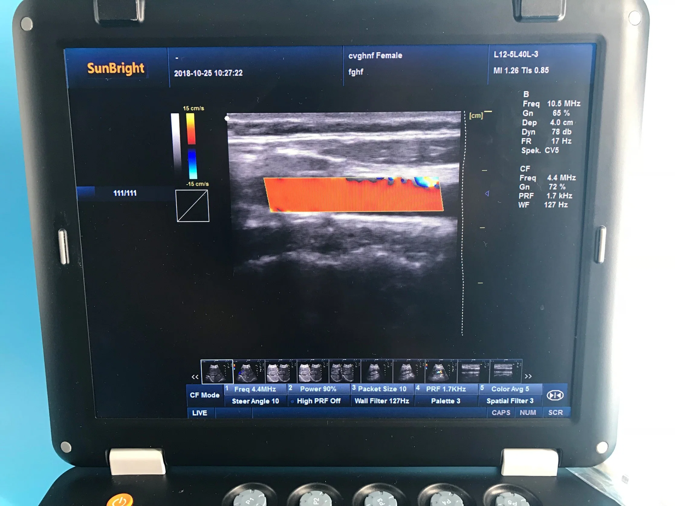 Portable Machine Vascular Abdominal Scan Color Doppler Ultrasound Triplex Duplex Pw Device